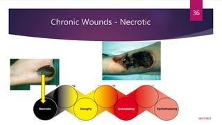 Chronic Wounds - Necrotic
10/27/2017
36
 