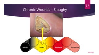 Chronic Wounds - Sloughy
10/27/2017
37
 