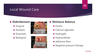 Local Wound Care
 Debridement
 Surgical
 Autolytic
 Enzymatic
 Biological
 Moisture Balance
 Foams
 Calcium alginates
 Hydrogels
 Hydrocolloids
 Adhesive films
 Negative pressure therapy
10/27/2017
46
 