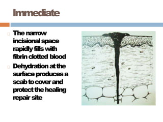 Immediate
Thenarrow
incisionalspace
rapidlyfillswith
fibrinclotted blood
Dehydrationatthe
surfaceproducesa
scabtocoverand
protectthehealing
repair site
 