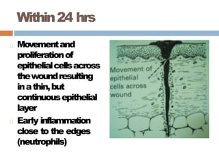Within24 hrs
Movementand
proliferationof
epithelialcellsacross
thewoundresulting
inathin,but
continuousepithelial
layer
Early inflammation
close to the edges
(neutrophils)
 