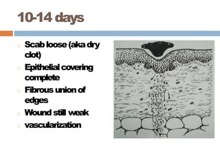 10-14 days
Scabloose(akadry
clot)
Epithelialcovering
complete
Fibrousunionof
edges
Woundstill weak
vascularization
 