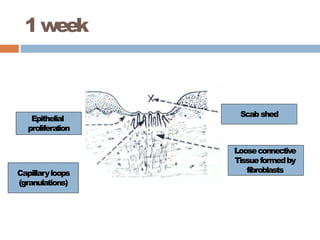 1week
Epithelial
proliferation
Capillaryloops
(granulations)
Scab shed
Looseconnective
Tissueformedby
fibroblasts
 