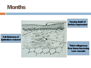 Months
Fullthicknessof
Epitheliumrestored
Varyingdepthof
Surfacedepression
Thickcollagenous
Scartissuebecoming
Less vascular
 