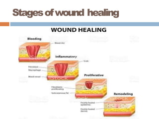 Stagesofwound healing
 