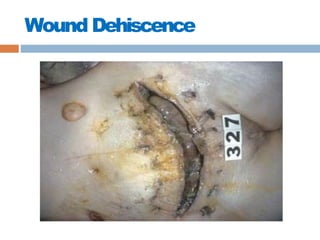 Wound Dehiscence
 