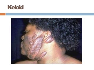 Keloid
 