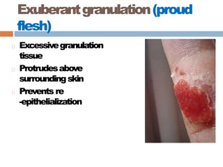 Exuberantgranulation(proud
flesh)
Excessivegranulation
tissue
Protrudesabove
surroundingskin
Prevents re
-epithelialization
 