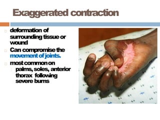 Exaggeratedcontraction
deformation of
surroundingtissueor
wound
Cancompromisethe
movementofjoints.
mostcommonon
palms,soles, anterior
thorax follow
ing
severe burns
 