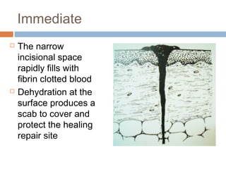 Immediate
 The narrow
incisional space
rapidly fills with
fibrin clotted blood
 Dehydration at the
surface produces a
scab to cover and
protect the healing
repair site
 