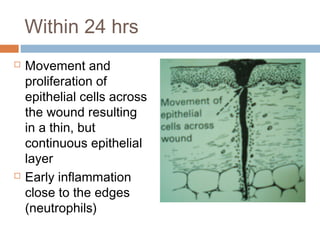 Within 24 hrs
 Movement and
proliferation of
epithelial cells across
the wound resulting
in a thin, but
continuous epithelial
layer
 Early inflammation
close to the edges
(neutrophils)
 