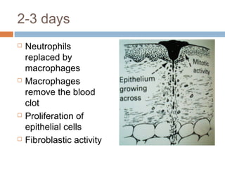 2-3 days
 Neutrophils
replaced by
macrophages
 Macrophages
remove the blood
clot
 Proliferation of
epithelial cells
 Fibroblastic activity
 