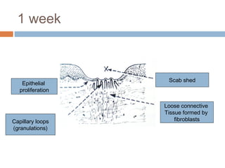 1 week
Epithelial
proliferation
Capillary loops
(granulations)
Scab shed
Loose connective
Tissue formed by
fibroblasts
 