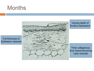 Months
Full thickness of
Epithelium restored
Varying depth of
Surface depression
Thick collagenous
Scar tissue becoming
Less vascular
 