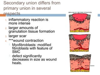 Secondary union differs from
primary union in several
respects
1. inflammatory reaction is
more intense
2. larger amounts of
granulation tissue formation
3. larger scar
4. ***wound contraction
 Myofibroblasts: modified
fibroblasts with feature of
SMC
 defect significantly
decreases in size as wound
heals.
 