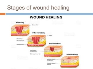 Stages of wound healing
 