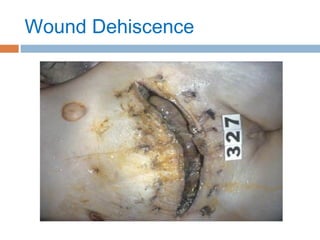 Wound Dehiscence
 
