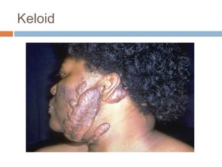 Keloid
 