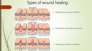 Wound healing | PPT