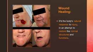 z
Wound
Healing:
❖ It's the body's natural
response to injury,
in an attempt to
restore the normal
structures and
functions.
 