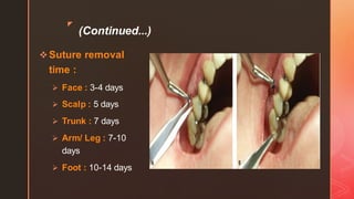 z
(Continued...)
❖Suture removal
time :
➢ Face : 3-4 days
➢ Scalp : 5 days
➢ Trunk : 7 days
➢ Arm/ Leg : 7-10
days
➢ Foot : 10-14 days
 