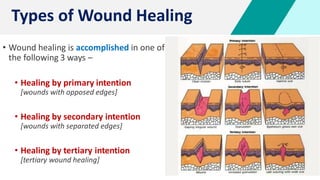 16
• Wound healing is accomplished in one of
the following 3 ways –
• Healing by primary intention
[wounds with opposed edges]
• Healing by secondary intention
[wounds with separated edges]
• Healing by tertiary intention
[tertiary wound healing]
Types of Wound Healing
 