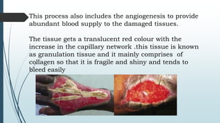 This process also includes the angiogenesis to provide
abundant blood supply to the damaged tissues.
The tissue gets a translucent red colour with the
increase in the capillary network .this tissue is known
as granulation tissue and it mainly comprises of
collagen so that it is fragile and shiny and tends to
bleed easily
 