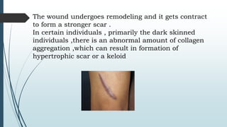 The wound undergoes remodeling and it gets contract
to form a stronger scar .
In certain individuals , primarily the dark skinned
individuals ,there is an abnormal amount of collagen
aggregation ,which can result in formation of
hypertrophic scar or a keloid
 