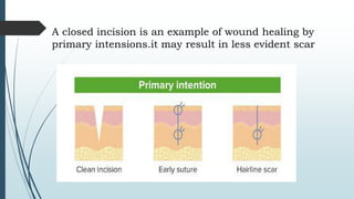 A closed incision is an example of wound healing by
primary intensions.it may result in less evident scar
 