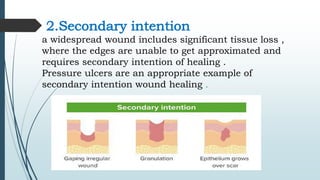 2.Secondary intention
a widespread wound includes significant tissue loss ,
where the edges are unable to get approximated and
requires secondary intention of healing .
Pressure ulcers are an appropriate example of
secondary intention wound healing .
 