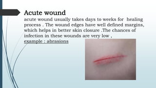 Acute wound
acute wound usually takes days to weeks for healing
process . The wound edges have well defined margins,
which helps in better skin closure .The chances of
infection in these wounds are very low ,
example : abrasions
 