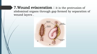 7.Wound evisceration : it is the protrusion of
abdominal organs through gap formed by separation of
wound layers .
 