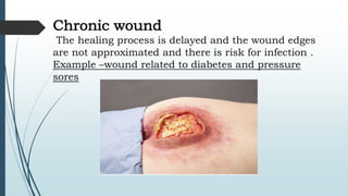 Chronic wound
The healing process is delayed and the wound edges
are not approximated and there is risk for infection .
Example –wound related to diabetes and pressure
sores
 