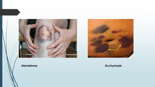 Hematoma Ecchymosis
 