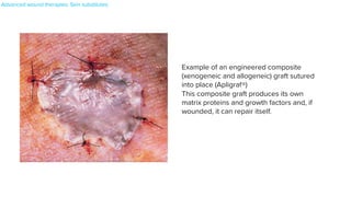 tiveness of HBOT68
. More studies are needed to examine the role of
HBOT in the treatment of chronic wounds and proper indications.
this sponge are human dermal fibroblasts that also produce multiple
matrix proteins and growth factors. As with all of the allogeneic and
Fig. 145.12 Example of an engineered composite (xenogeneic and
allogeneic) graft sutured into place (Apligraf®). Courtesy, Gregg M Menaker, MD.
Fig. 145.13 Negative pressure wound therapy. In negative pressure wound
therapy, a polyurethane (this patient) or polyvinyl alcohol foam is cut and
placed on the wound surface. The foam is then sealed over by a transparent
drape. A vacuum pump, connected via a plastic tube, provides a negative
pressure environment. The sterile polyurethane foam has large pores and
stimulates granulation
Example of an engineered composite
(xenogeneic and allogeneic) graft sutured
into place (Apligraf®)


This composite graft produces its own


matrix proteins and growth factors and, if
wounded, it can repair itself.
Advanced wound therapies: Skin substitutes
 