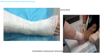 fibers. In contrast, inelastic bandages such as
stretch bandage (more commonly used in Euro
that resists lateral expansion of the calf musc
tions. Of note, contractions of the calf muscle
ates a propelling force to promote venous retu
Compression bandages may be composed o
multiple combined components. In a recen
stretch bandages were found to be as efficacio
of venous leg ulcers as more complex mul
systems, in both ambulatory and non-ambul
Cochrane reviews suggest that the evidence su
systems (over single-component systems) and
component (over those with an inelastic band
Compression devices
Intermittent pneumatic compression (IPC) d
pressure to the limb. IPC is a beneficial adjunc
pression in the treatment of venous leg ulc
ambulatory patients80,81
. When the calf muscl
use of a dynamic compression system is more
or abnormal pressure to the limb, compromised circulation, skin
breakdown, additional ulcer formation, or further limb deterioration
Fig. 145.14 Unna boot. Nonelastic compression therapy with a zinc-
impregnated compression wrap.
eFig. 145.3 A foam dressing.
eFig. 145.4 Example of a collagen–alginate complex dressing. The rope form
can be used to pack deep wounds. Courtesy, Gregg M Menaker, MD.
eFig. 145.5 Graduated compression stockings being applied.
Unna boot
Graduated compression dressings
Advanced wound therapies: Compression therapy
 