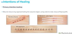 -Intentions of Healing
-Primary Intention healing:


-Wound closure by approximating the wound edges using side-to-side closure/
fl
aps/grafts
 