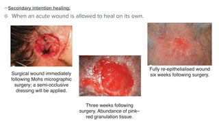 -Secondary intention healing:


When an acute wound is allowed to heal on its own.


Fully re-epithelialised wound
six weeks following surgery.
Three weeks following
surgery. Abundance of pink–
red granulation tissue.
Surgical wound immediately
following Mohs micrographic
surgery; a semi-occlusive
dressing will be applied.
 