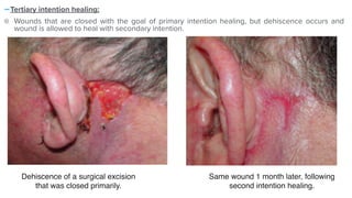 -Tertiary intention healing:


Wounds that are closed with the goal of primary intention healing, but dehiscence occurs and
wound is allowed to heal with secondary intention.


Dehiscence of a surgical excision
that was closed primarily.
Same wound 1 month later, following
second intention healing.
 