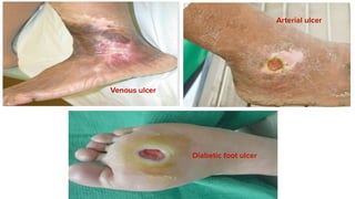 Venous ulcer
Arterial ulcer
Diabetic foot ulcer
 