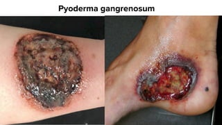 Pyoderma gangrenosum
 