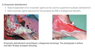 3. Enzymatic debridement:


Topical application of an enzymatic agent can be used to supplement autolytic debridement


Only enzymatic agent approved for this purpose by FDA is Collagenase (SantylR).
The Unna boot is a type of compression bandage which has been used for many years in the treatment of stasis ulcers.
It was originally a cotton bandage impregnated with zinc oxide, gelatin and glycerin paste.
Figs. 4.5A and B. Enzymatic debridement using Papain, collagenase dressings. The
photograph is before and after 10 days of papain dressing.
Applied in a semirigid state, Unna boot confers the dual advantage of compression along with the moisture retentive
properties of an occlusive dressing. It should be applied by qualified medical personnel and changed at least weekly.
Nowadays, flexible compression bandages are more preferred (when compared to the rigid nature of Unna's boot).
They come in different varieties—elastic/inelastic, single/multilayered, long- or short-stretch compression, etc. The
major concern is in identifying how much tension is needed while prescribing elastic compression bandages.7
Enzymatic debridement using Papain, collagenase dressings. The photograph is before
and after 10 days of papain dressing.
Dressings in Dermatosurgery
The Unna boot is a type of compression bandage which has been used for many years in the treatment of stasis ulcers.
It was originally a cotton bandage impregnated with zinc oxide, gelatin and glycerin paste.
Figs. 4.5A and B. Enzymatic debridement using Papain, collagenase dressings. The
photograph is before and after 10 days of papain dressing.
Applied in a semirigid state, Unna boot confers the dual advantage of compression along with the moisture retentive
properties of an occlusive dressing. It should be applied by qualified medical personnel and changed at least weekly.
Nowadays, flexible compression bandages are more preferred (when compared to the rigid nature of Unna's boot).
They come in different varieties—elastic/inelastic, single/multilayered, long- or short-stretch compression, etc. The
major concern is in identifying how much tension is needed while prescribing elastic compression bandages.7
The authors have used papain dressings and amniotic membrane dressings to good effect in leg ulcers (Figs. 4.5 and
 