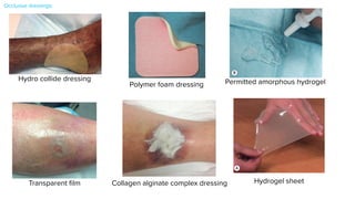 Composites
The designs of occlusive dressings are constantly changing with the
goal of improved and simplified care for a greater range of wounds.
Several new types of composite dressings, which combine two or more
types of semi-occlusive dressings into one product, are commercially
available. They have three components: (1) a semi- or non-adherent
layer that contacts the wound (like a hydrogel, hydrocolloid, foam or
alginate; Fig. 145.10); (2) an absorptive layer; and (3) an outer layer
(like a film with an adhesive border). This maximizes the efficiency and
comfort of the dressing by expanding absorbency as well as lessening
the chance of maceration50
. Other features include the lack of need for
secondary retention dressings and better waterproof coverings, which
enable the patient to shower or bathe.
Dressings That Reduce Wound Protease Levels
Matrix metalloproteinases (MMPs) are a family of proteolytic enzymes
that play a role in cellular migration during the inflammatory phase of
healing and whose levels are elevated in non-healing chronic wounds
(see Ch. 141). Dressings composed of a mixture of extracellular matrix
proteins, bovine collagen, and oxidized regenerated cellulose have been
designed which act as a substrate (sink) for MMPs51
. In addition, the
enzymatic activity of MMPs is reduced via ion exchange.
ADVANCED WOUND THERAPIES
particles to the continuous medium and to the proportion of water
within that medium. This property accounts for the absorptive and
expansive capacity of colloid gels, which function as a semipermeable
membrane. Gel swelling occurs because the particle concentration of
the gel is usually higher than that of the surrounding medium, thereby
drawing water from the surroundings into the gel.
Hydrocolloid dressings were first employed as ostomy products and
are now available in multiple forms. The most commonly used hydro-
colloid dressings (e.g. DuoDERM®) are available as sheets with an inner
adhesive layer consisting of a hydrophilic colloid base that is a mixture
of pectin, karaya, guar or carboxymethyl cellulose plus an adhesive con-
taining polyisobutylene, styrene isoprene, or ethylene vinyl acetate (Fig.
145.9). The outer layer is composed of a thin semipermeable material
such as polyurethane. A gel is formed in the presence of wound exudate,
and as a unit, the dressing is semipermeable to water vapor and gases45
.
Another type of hydrocolloid dressing is a synthetic, non-adherent,
high-density plastic woven polymer (e.g. N-Terface®). Fluid is able to
flow through this matrix to be absorbed by an overlying dressing
without adherence to the new epithelial surface.
Advantages/disadvantages
When in sheet form, these dressings can be cut and conformed to the
shape of the wound. They are waterproof and adhere directly; as a
result, they do not require a secondary dressing. In addition, these
dressings have a cushioning or pressure-relieving effect (especially at
bony sites), which increases as the dressing absorbs exudate. The result-
ing colloidal gel that forms prevents the dressing from adhering to the
wound base. Accumulation of the exudate itself in a moist, semiperme-
able environment becomes a source of phagocytic cells and endogenous
enzymes. This feature, along with the gel, results in autolytic debride-
ment that can be washed away with saline irrigation of the wound
Fig. 145.9 Hydrocolloid dressing placed over a healing wound on the ankle.
This example is DuoDERM®.
Fig. 145.10 Choice of dressing based on wound depth and exudate. Courtesy,
Gregg M Menaker, MD.
CHOICE OF DRESSING BASED ON WOUND DEPTH AND EXUDATE
Wound
depth
Wound drainage
Foam
Hydrocolloid
Alginate
Film
Gel
Thin Thick
Fig. 145.7 Hyd
A Hydrogel she
B Premixed am
hydrogel.
A
CHAPTER
145
Dressings
Fig. 145.7 Hydrogels.
A Hydrogel sheet.
B Premixed amorphous
hydrogel.
A
B
Fig. 145.8 Collagen–alginate complex dressing. Alginate dressings have
hemostatic effects and can be used post
N
1
Fig. 145.5 A transparent film dressing is used to occlude a dry wound. This
example is Tegaderm™.
Fig. 145.6 Polymer foam dressing. It consists of hydrophilic foam with a
hydrophobic backing (pink).
dressing; permeability to water vapor; and tendency to reduce postop- Ideally, once a foam dressing has absorbed some amount of exudate, it
SEC TION
21
SURGERY
Fig. 145.5 A transparent film dressing is used to occlude a dry wound. This
example is Tegaderm™.
Fig. 145.6 Polymer foam dressing. It consists of hydrophilic foam with a
hydrophobic backing (pink).
dressing; permeability to water vapor; and tendency to reduce postop-
erative pain. It is also thought to enhance re-epithelialization of graft
donor sites, with a reported increase in healing rates of 25–45%36
. One
disadvantage of film dressings is that they are difficult to place properly,
requiring uniform tension on the film to prevent wrinkling and its
adherence to itself (similar to what is experienced with Saran™ Plastic
Wrap). As the film usually only adheres to intact skin, a 1–2 cm appli-
cation margin is recommended. In addition, due to shearing forces, it
is best to avoid using films on thin or fragile skin.
Films may adhere to the wound as drying progresses, thereby risking
disruption or stripping of the newly formed epithelium that is not yet
tightly bound to the underlying dermal layer. It is also possible to trau-
matize newly grafted skin tissue during dressing changes. For these
reasons, it is advisable to allow the film dressing to remain in place
until it spontaneously falls off, which occurs after 1–2 weeks37
. Any
wrinkling of the film during placement can create a conduit for bacterial
penetration and leakage of wound exudate. It is therefore recommended
that for exudative wounds the film have a complete 2–3 cm adhesion
margin to prevent this leakage.
Another disadvantage of film dressings is that they are non-absorbent;
therefore, wound fluid can accumulate under the dressing layer, espe-
cially with highly exudative wounds. This is often the case during the
first 7–10 days after the creation of a wound, with the adherent proper-
ties of film dressings making frequent changing undesirable.
Foams
Polymer foams are semi-occlusive, bilaminate, and polyurethane- or
silicone-based dressings. They consist of a hydrophilic foam with a
hydrophobic backing, which can prevent leakage, provide a barrier
against bacterial penetration, and provide the moist environment
afforded by films, but with the addition of some absorbency (Fig. 145.6).
The inner layer is composed of an absorbent, gas-permeable polyure-
thane foam mesh, which lies adjacent to the wound. The outer layer
is a semipermeable, non-absorbent membrane composed of polyure-
thane, polyester, silicone or Gore-Tex®, surrounded by a polyoxyethyl-
Ideally, once a foam dressing has absorbed some amount of exudate, it
should be able to retain that fluid, even if exposed to pressure. Some
brands are described as having such a quality.
Advantages/disadvantages
Although very absorbent, there is a limit to the amount of wound
exudate this type of dressing can absorb. Therefore, it should be changed
every 1–3 days. The permeability of foams to both gas and water vapor
makes them suitable for mild to moderately exudative wounds, although
there are brands designed for heavily exudative wounds.
Silicone-based rubber foams, known as silastic foams, are composed
of a silicone mixture to which a stannous octoate catalyst has been
added. This type molds and contours to the shape of the wound and
therefore can be used for packing cavities or deep ulcers such as piloni-
dal sinuses. The additional advantages are absorbency, non-adherence,
increased comfort for the patient, a tendency to be less expensive,
and dressing changes that do not generally require skilled nursing
care38
.
The disadvantages of foam dressings are the inability to use them
with dry wounds, their opacity, which prevents visual monitoring of
the wound, and the need for frequent changing, perhaps as often as
every day. Infrequent changing could risk incorporation of the dressing
material into the wound itself. There is also the possibility of an unde-
sirable drying effect of the wound if drainage is insufficient to maintain
a moist environment.
Hydrogels
As their name implies, hydrogels are composed primarily of water – up
to 96% of the content. This dressing type consists of a cross-linked
hydrophilic polymer network composed of polyvinyl alcohol, polyacryl-
amide, polyethylene oxide or polyvinyl pyrrolidone; it is produced as
sheets, amorphous gels (pre-mixed or dry), or as impregnated dressings
(Fig. 145.7). Hydrogels are semitransparent (allowing visual inspection
of the wound), have a high absorptive capacity (between 100% and
Transparent
fi
lm
Hydro collide dressing
Polymer foam dressing
Hydrogel sheet
Collagen alginate complex dressing
In general, the sheet form of a hydrogel dressing is constru
sandwiching the hydrophilic polymer between two removab
sheets of polyethylene film, with some types containing a su
inner gel mesh. For application to the wound, the film on the
side is removed, leaving the outer film in place. With this m
application, the dressing is semipermeable to gases (including
and water vapor. If the outer film is also removed, then the
becomes permeable to fluid as well; as a result, exudate can p
secondary gauze dressing. The polymer sheets can be remove
without trauma to the wound bed.
The amorphous type of hydrogel is composed of a cornstarch-
polymerized compound that forms a gel upon hydration at the
its use. It is available commercially in a powdered or pre-mixe
is applied wet to the wound defect, requires a secondary outer d
and requires water application to the surface for removal.
Advantages/disadvantages
One significant advantage of hydrogel dressings is a reduction
operative pain and inflammation. Another is that hydrogels ha
shown to accelerate the rate of wound healing when compared
A
B
Permitted amorphous hydrogel
Occlusive dressings:
 