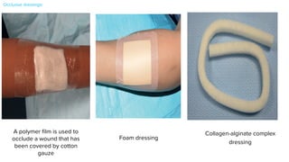 eFig.145.2Apolymer
filmisusedtooccludea
woundthathasbeen
coveredbycotton
gauze.Courtesy,GreggM
Menaker,MD.
eFig.145.3Afoamdressing.
eFig
film
wou
cove
gau
Mena
eFig.
145.4
Example
of
a
collagen–alginate
complex
dre
can
be
used
to
pack
deep
wounds.
Courtesy,
Gregg
M
Menaker,
M
eFig.145.4 Exampleofacollagen–alginatecomplexdressing.The rope form
can be used to pack deep wounds. Courtesy,GreggMMenaker,MD.
A polymer
fi
lm is used to
occlude a wound that has
been covered by cotton
gauze
Collagen-alginate complex
dressing
Foam dressing
Occlusive dressings:
 