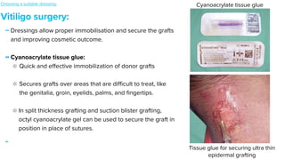 -Dressings allow proper immobilisation and secure the grafts
and improving cosmetic outcome.


-Cyanoacrylate tissue glue:


Quick and e
ff
ective immobilization of donor grafts


Secures grafts over areas that are di
ffi
cult to treat, like
the genitalia, groin, eyelids, palms, and
fi
ngertips.


In split thickness grafting and suction blister grafting,
octyl cyanoacrylate gel can be used to secure the graft in
position in place of sutures.


-
Vitiligo surgery:
Choosing a suitable dressing: Fig. 4.7. Cyanoacrylate tissue glue.
The tiny droplets of octyl cyanoacrylate are expressed from the needle tip; broken further into even smaller droplets
by taking it on another sterile needle tip, and applied only at four points, at 12, 3, 6 and 9 o'clock positions between the
edges of the donor grafts and the recipient wells. The adhesion between the graft and the recipient wells start within
10 seconds and is complete within 1 minute of application. No dressing or immobilization is required in any patients.
Apart from the adhesive property, octyl cyanoacrylate also exhibits antimicrobial properties against staphylococci,
Pseudomonas, and E. coli.23
Alternatively, paraffin embedded nonadherent sterile gauze (Jelonet®
) can be applied as a primary dressing followed
by surgical pad and elastic adhesive dressings to immobilize the area (Fig. 4.8).
In split thickness grafting and suction blister grafting, octyl cyanoacrylate gel can be used to secure the graft in position
in place of sutures (Figs. 4.9A and B). Adhesive film dressings like Opsite®
can be used as secondary dressings over the
recipient site. Opsite is a transparent, adhesive film. The film is moisture vapor permeable, conformable and extensible
which is widely used to provide a moist wound environment for superficial wounds. Opsite provides moisture vapor
permeability, allowing the excess exudate to evaporate, helping to prevent skin maceration. The grafts can also be
placed in position using sutures or without sutures and further dressed with absorbent pads and hydrofilm dressings.
Lukomed T plus®
is a film dressing with absorbent pad which can be directly applied over a grafted site.
14
- 19-July-2019 10:25:15
Cyanoacrylate tissue glue
Dressings in Dermatosurgery
Figs. 4.9A and B. Tissue glue for securing grafts in SBEG, ultrathin epidermal grafting—
applied over the periphery of grafts to secure them in place.
Tissue glue for securing ultra thin
epidermal grafting
 