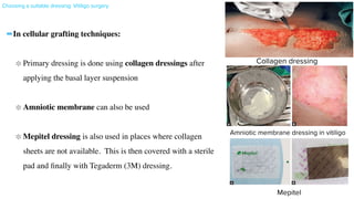 Choosing a suitable dressing: Vitiligo surgery
16
- 19-July-2019 10:25:15
Dressings in Dermatosurgery
Figs. 4.11A and B. Amniotic membrane dressings in vitligo surgery.
Figs. 4.12A and B. Mepitel dressings.
Recently, authors have found a new self-adhesive bandage without any chemical adhesive namely Coban®
to be very
effective in nail surgeries. The advantage being nonallergic and can be easily reapplied if the patient feels the dressing
too tight without disturbing the inner layers of the dressing. It is a stretchable and self-adhesive dressing suitable for
pressure dressings and also provides effective hemostasis (Figs. 4.13A to D).
Dressings in Dermatosurgery
Figs. 4.11A and B. Amniotic membrane dressings in vitligo surgery.
Figs. 4.12A and B. Mepitel dressings.
Recently, authors have found a new self-adhesive bandage without any chemical adhesive namely Coban®
to be very
effective in nail surgeries. The advantage being nonallergic and can be easily reapplied if the patient feels the dressing
too tight without disturbing the inner layers of the dressing. It is a stretchable and self-adhesive dressing suitable for
pressure dressings and also provides effective hemostasis (Figs. 4.13A to D).
-In cellular grafting techniques
:

Primary dressing is done using collagen dressings after
applying the basal layer suspension
 

Amniotic membrane can also be used
 

Mepitel dressing is also used in places where collagen
sheets are not available. This is then covered with a sterile
pad and
fi
nally with Tegaderm (3M) dressing.
Collagen dressing
Amniotic membrane dressing in vitiligo
Mepitel
 