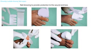 Dressings in Dermatosurgery
Figs. 4.14 A to E. Nail dressing to provide protection to the wounds and the toes.
Dressings in Dermatosurgery
Figs. 4.14 A to E. Nail dressing to provide protection to the wounds and the toes.
• If the dressing is highly absorptive, then more frequent dressing c
and management of the cause of the exudate (such as infection).
Dressings in Dermatosurgery
l dressing to provide protection to the wounds and the toes.
Nail dressing to provide protection to the wound and toes
Choosing a suitable dressing: Nail surgery
 