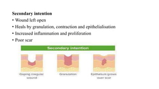 Secondary intention
• Wound left open
• Heals by granulation, contraction and epithelialisation
• Increased inflammation and proliferation
• Poor scar
 