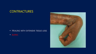 CONTRACTURES
•
• BURNS
 