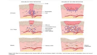 WOUND HEALING ,KELOIDS AND HYPERTROPHIC SCARS BY DR ABRAHAM.pptx